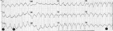 Initial 12-lead ECG for the shocked patient with an AICD.