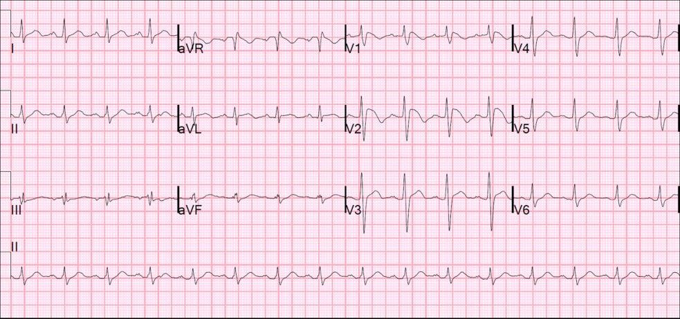 12-lead ECG for the syncope question.