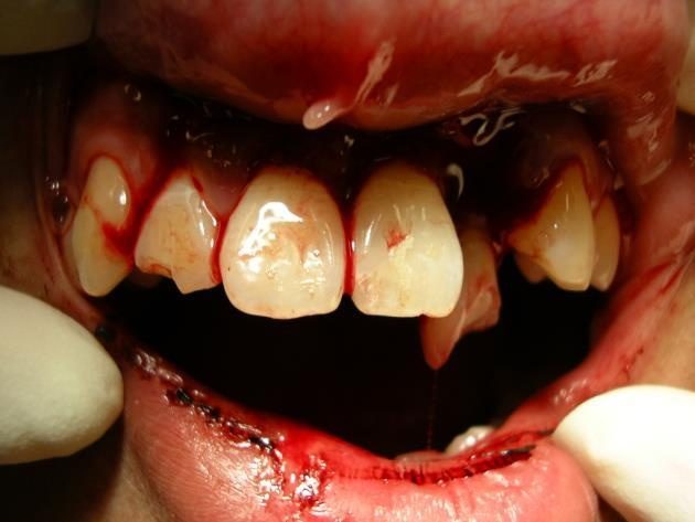 Clinical image of dental trauma after a fall.