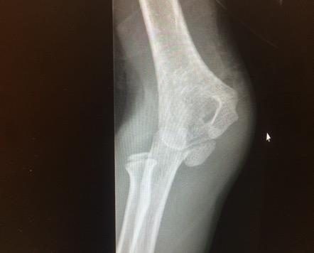 AP elbow X-ray for the paediatric elbow injury question.