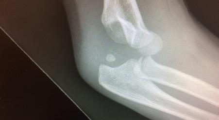 Lateral elbow X-ray for the paediatric elbow injury question.