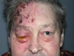 Clinical image of a painful facial rash.