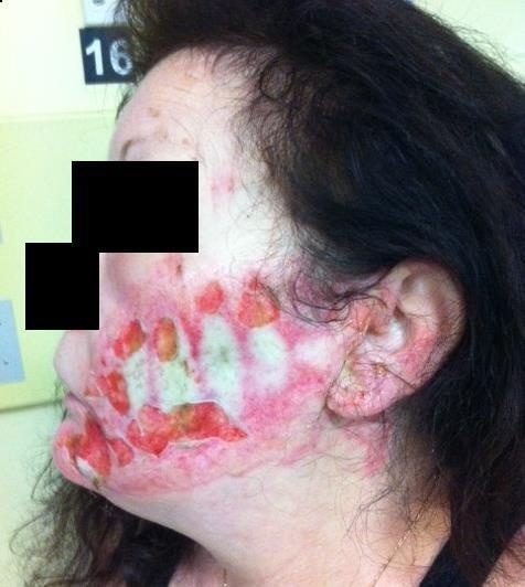 Clinical image of a facial burn after contact with a heater.