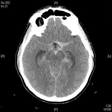 Axial CT brain image for sudden headache question.