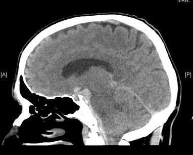 Sagittal CT brain image for sudden headache question.