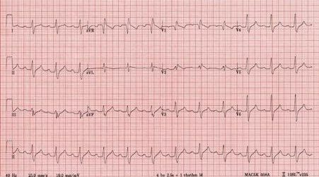 12-lead ECG for increasing drowsiness question.