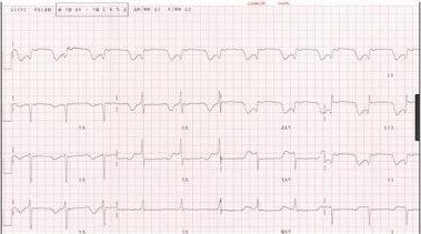 12-lead ECG for epigastric pain question.