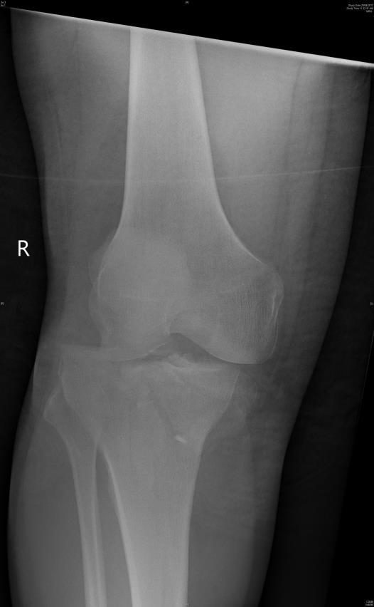 AP right knee X-ray after motorcycle crash.