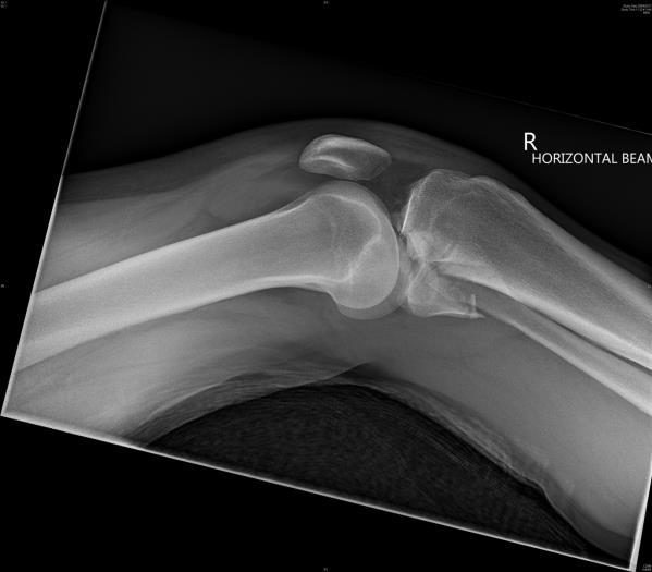 Lateral right knee X-ray after motorcycle crash.