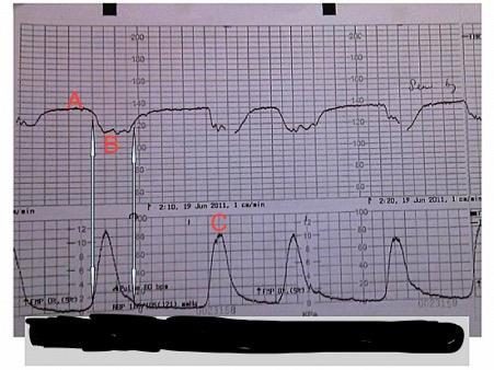 CTG tracing for late-pregnancy epigastric pain and headache question.