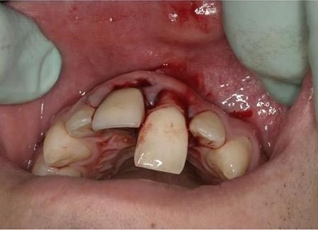 Clinical intraoral image for paediatric mouth injury question.