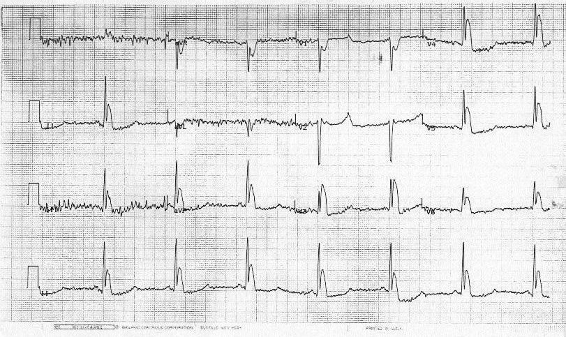 12-lead ECG after cold-water immersion.