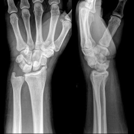 Left wrist X-ray after fall onto hand.