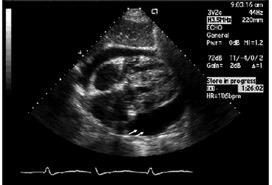 Bedside subcostal ultrasound image in an elderly patient with chest pain and collapse