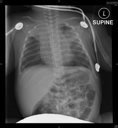 Portable chest X-ray of a 4-week-old infant with respiratory distress