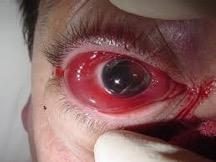 Clinical eye photograph after blunt ocular trauma