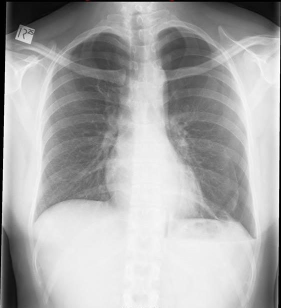 Chest X-ray of a 15-year-old boy with shortness of breath