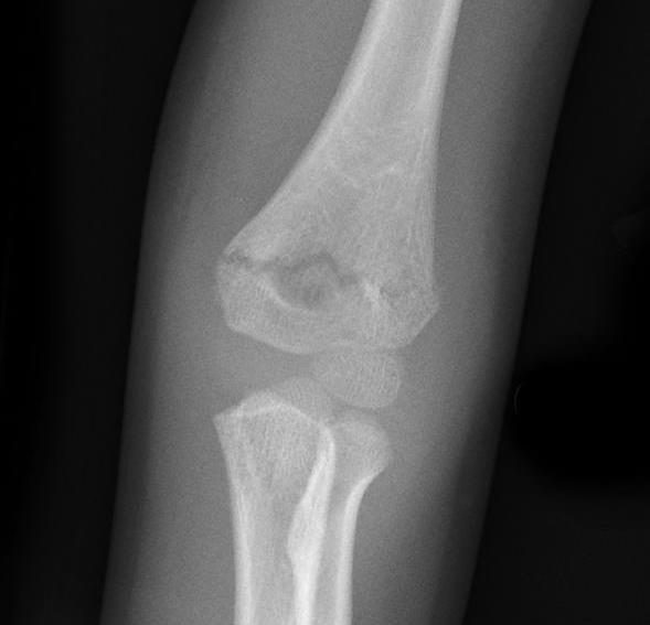 AP elbow X-ray for a 4-year-old after a fall