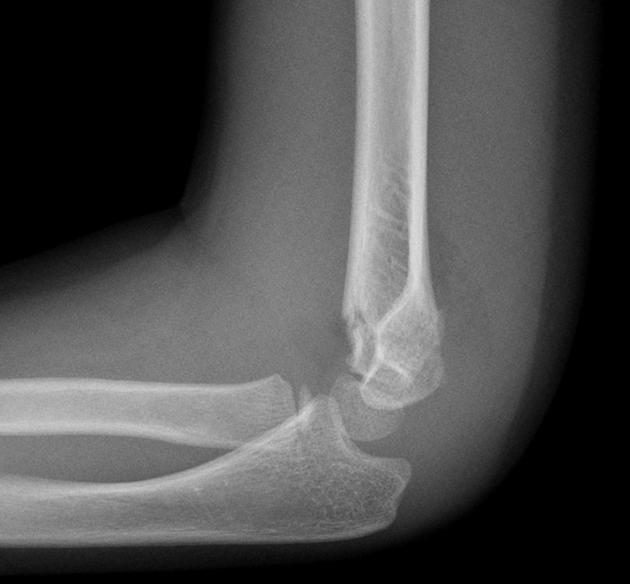 Lateral elbow X-ray for a 4-year-old after a fall