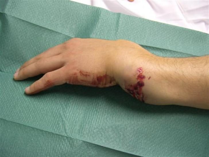 Clinical photograph of swollen, deformed wrist with skin breach and bleeding after fall onto outstretched hand