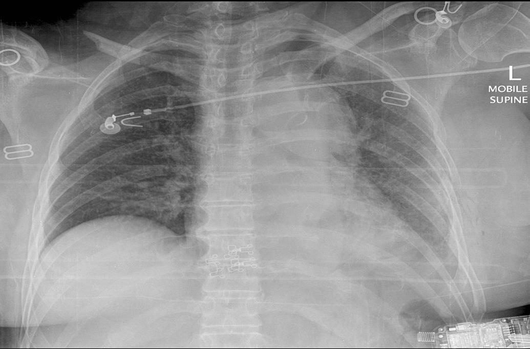 Chest X-ray from high-speed motorbike trauma