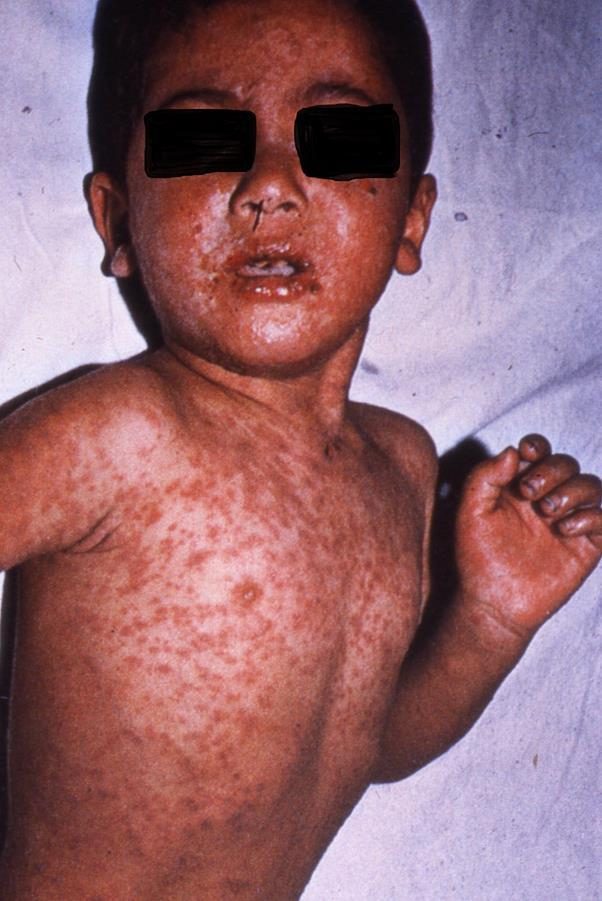 Clinical photograph of paediatric febrile rash