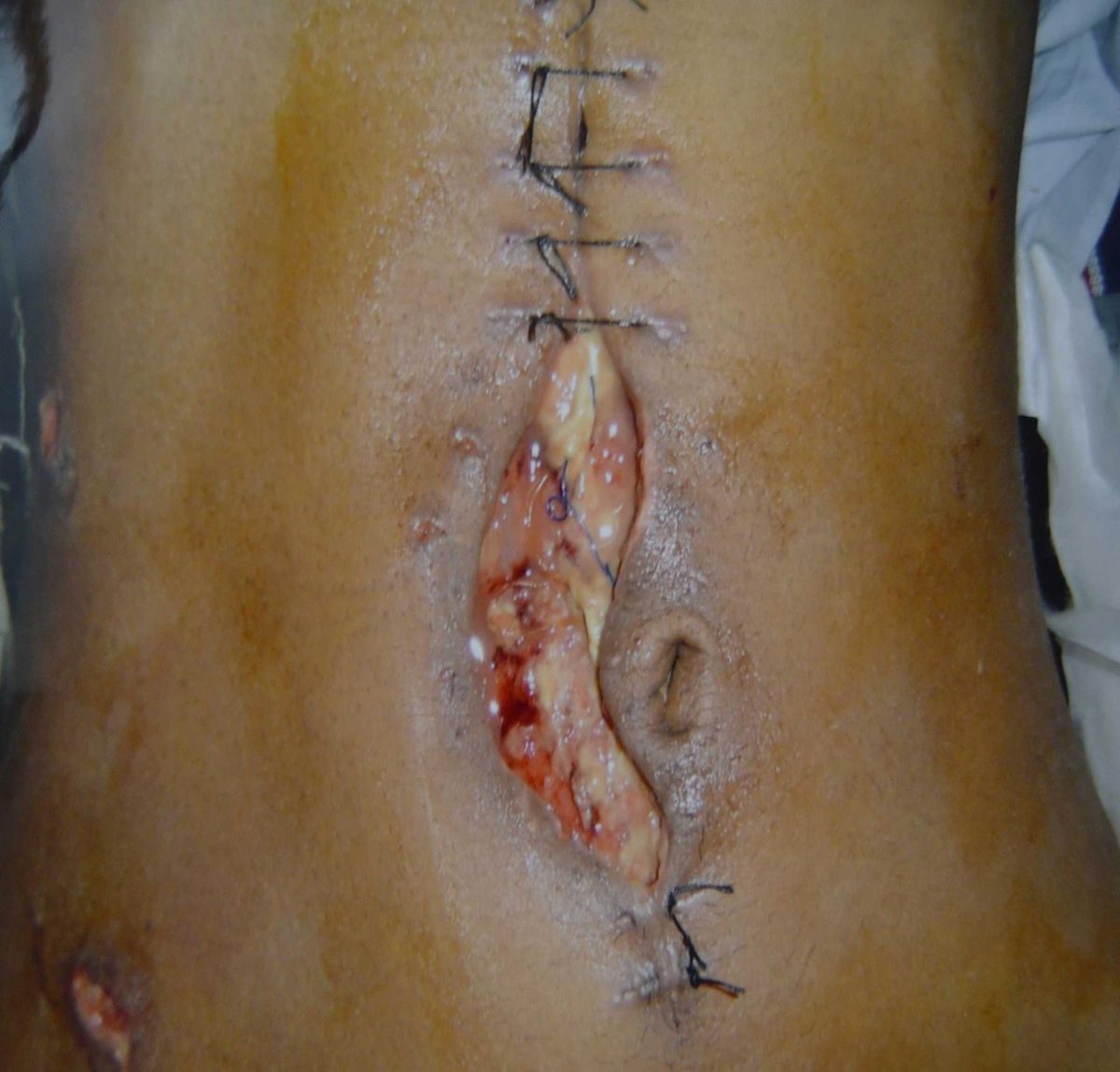 Abdominal post-laparotomy wound photograph