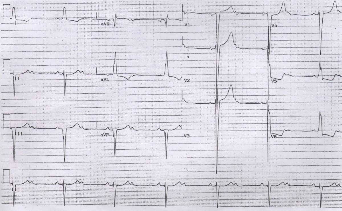 Post-ROSC ECG after cold-water drowning