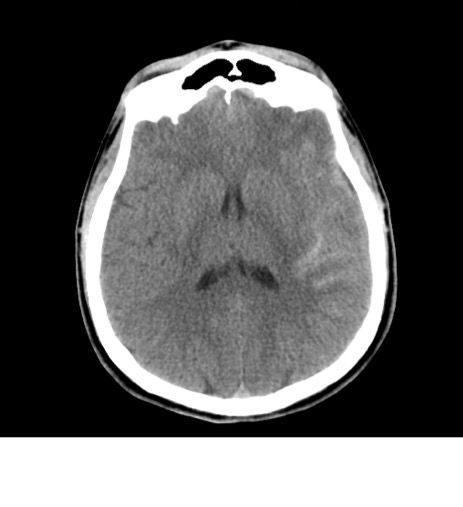Axial non-contrast CT brain slice