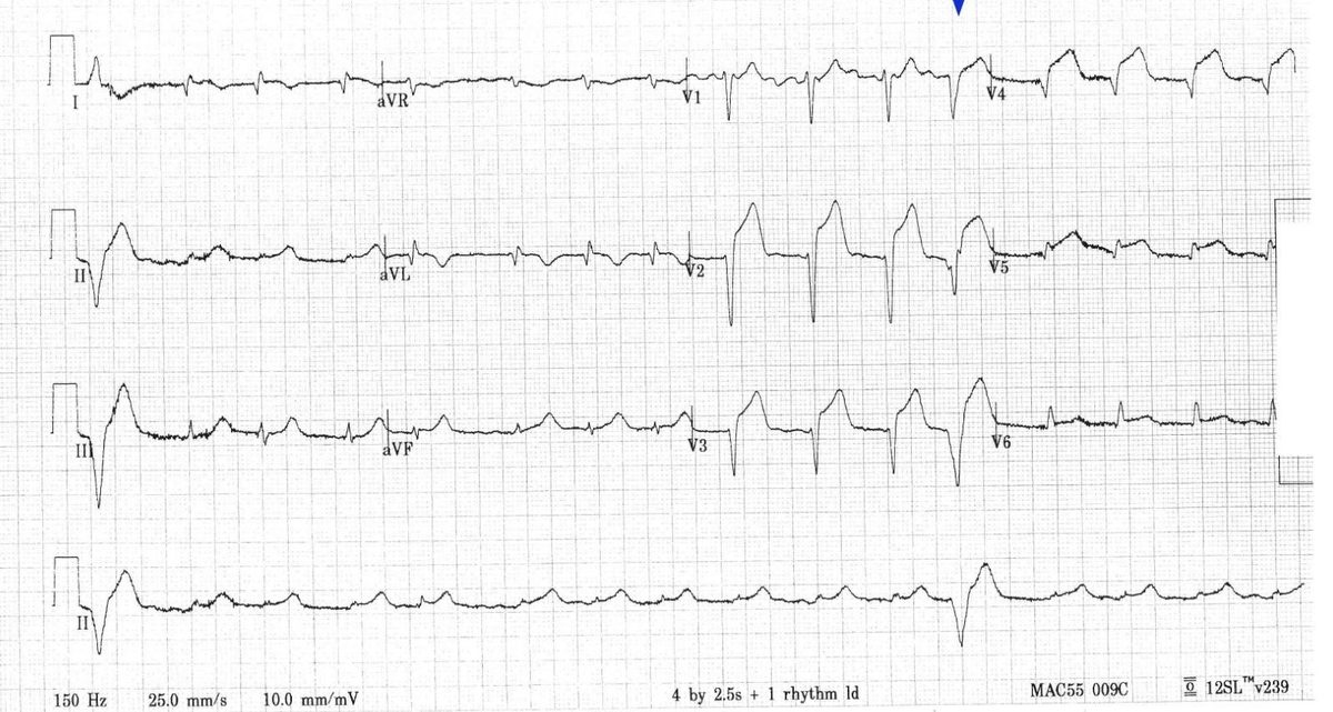 Twelve-lead ECG from patient with chest pain