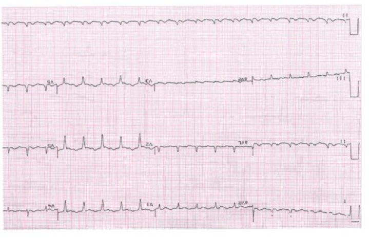 ECG from a patient with shock and dyspnoea