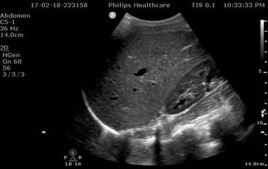 Paediatric FAST ultrasound image 1