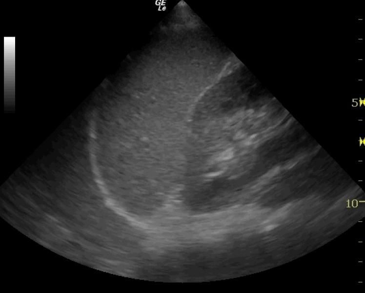 Paediatric FAST ultrasound image 3
