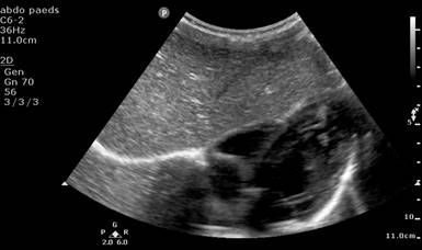 Paediatric FAST ultrasound image 4