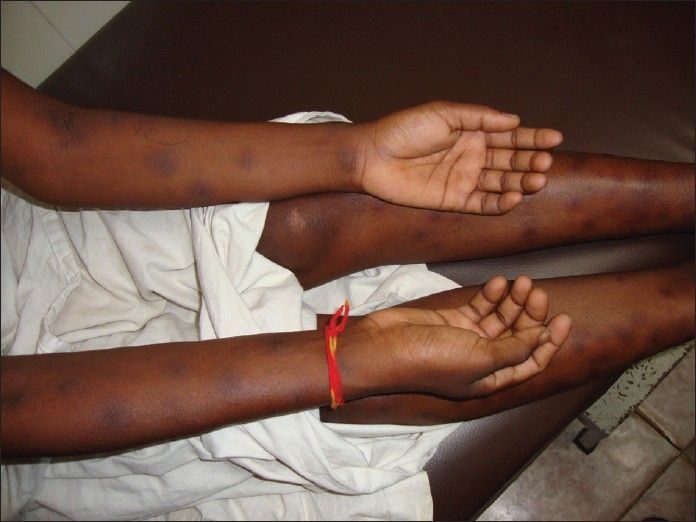 Clinical photograph of tender nodular lesions on the lower limbs