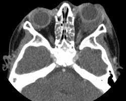Axial CT orbit after facial trauma