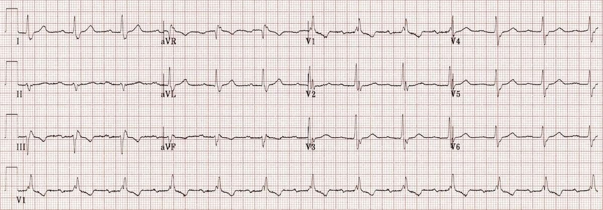 ECG from a patient with recurrent falls