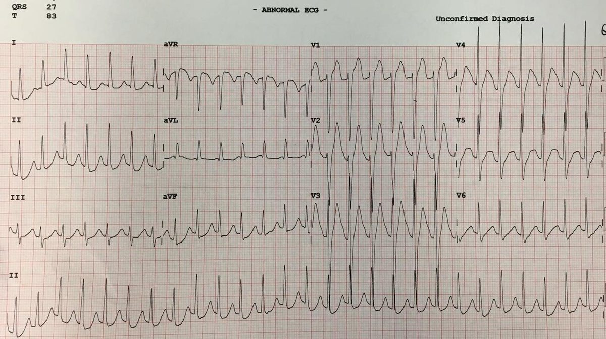 ECG after cocaine use