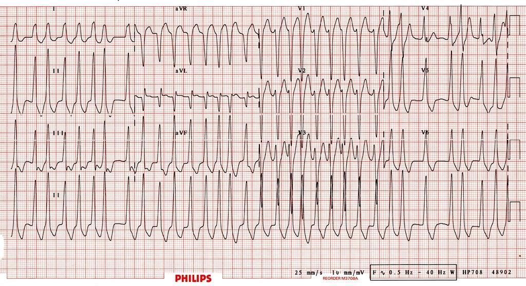 Initial ECG from a patient with palpitations
