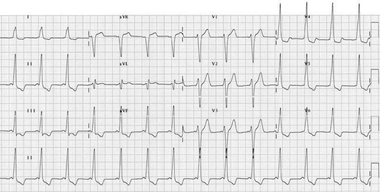 Post-treatment ECG from the same patient