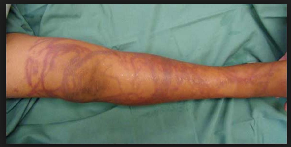 Clinical photograph of a leg after ocean exposure