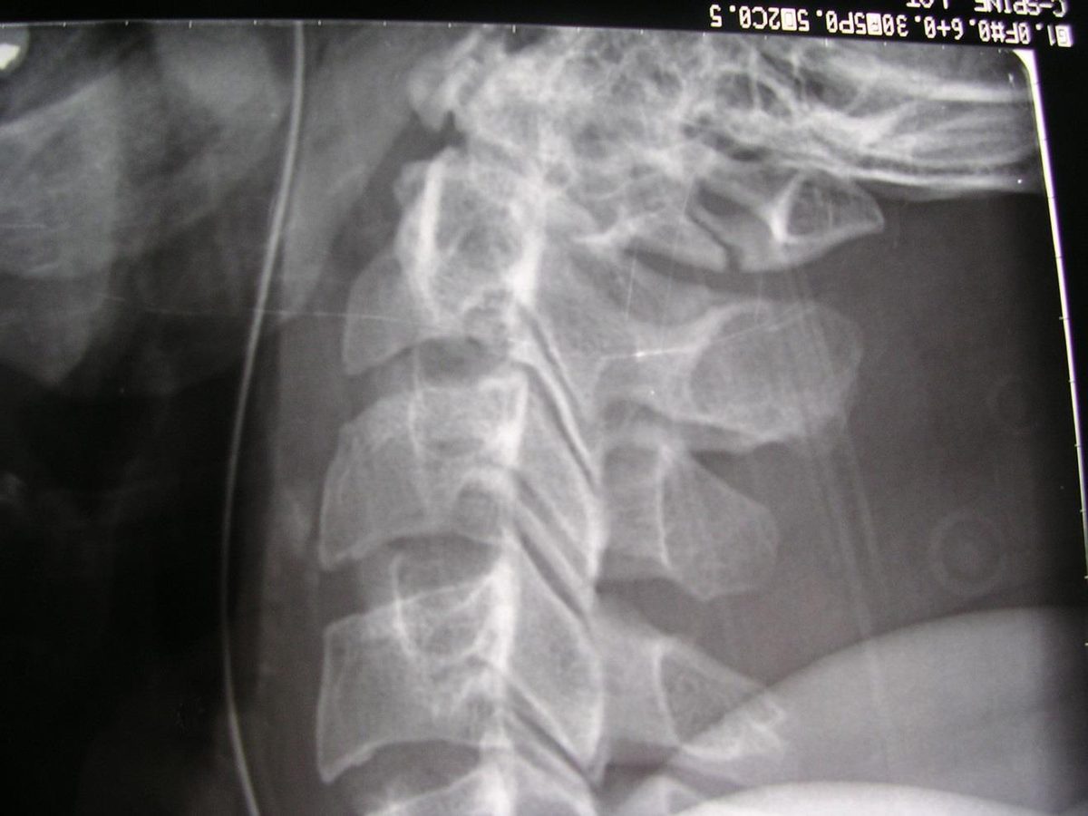 Lateral cervical spine X-ray after fall and intubation