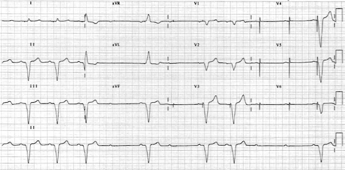 ECG from an elderly patient with dizziness