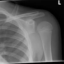 AP shoulder X-ray after fall