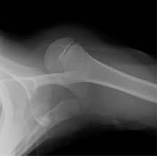 Axillary shoulder X-ray after fall
