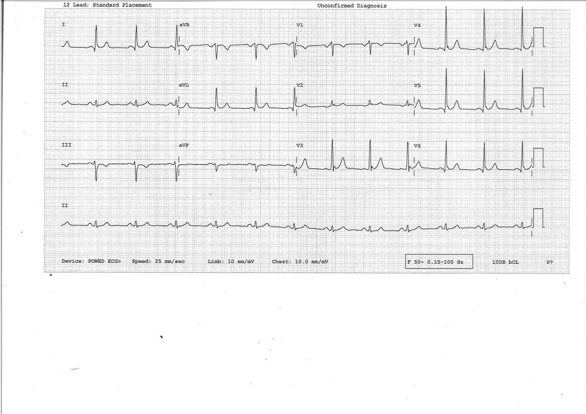 ECG from a patient with palpitations during swimming