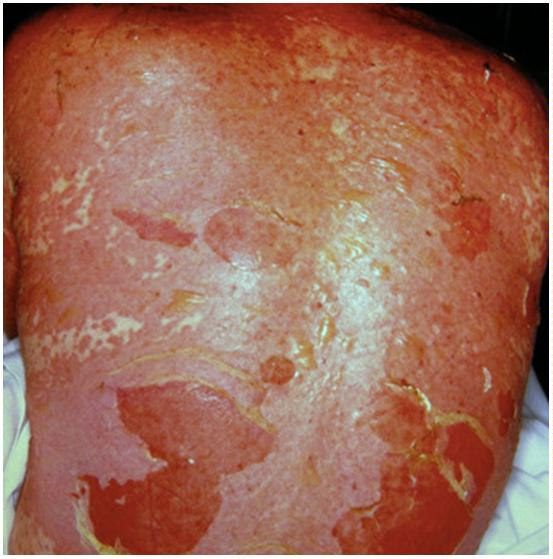 Rash after commencing co-trimoxazole