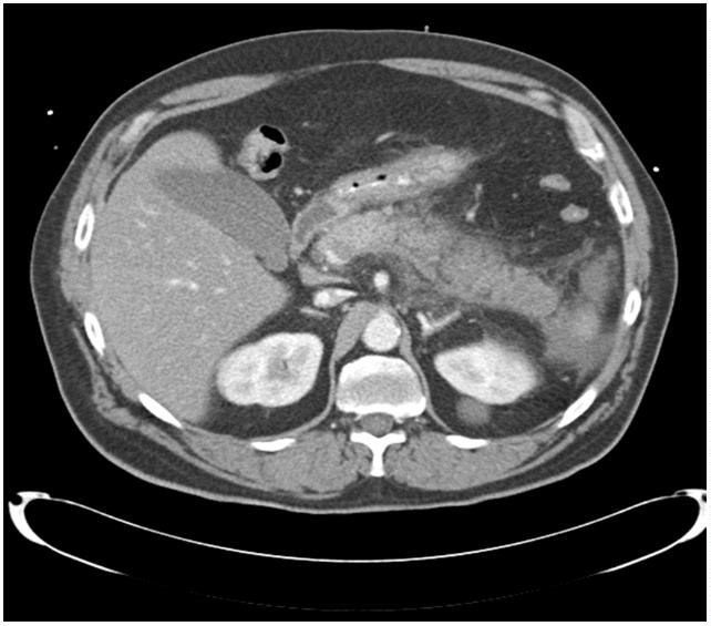 CT abdomen after initial stabilisation