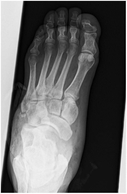 On-table foot X-ray after crush injury