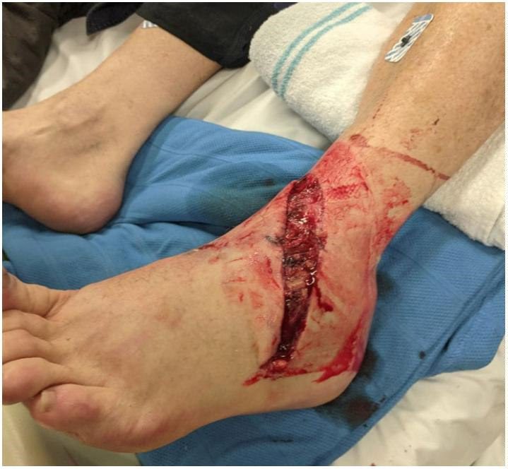 Photograph of the foot injury after crush